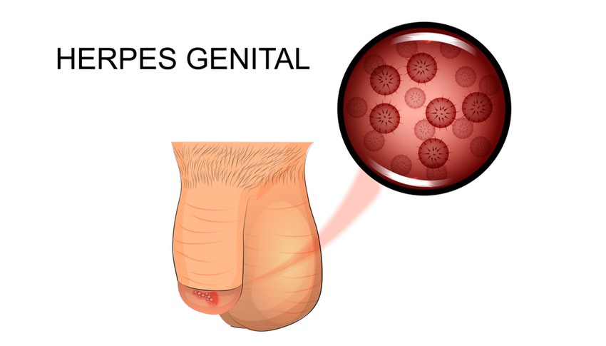 Férfiaknál a hímvessző bármely részén megjelenhetnek a herpeszes hólyagok. Nőknél leginkább a szeméremtesten fordulhatnak elő, de gyakran a hüvelyre és a méhnyakra is átterjednek.