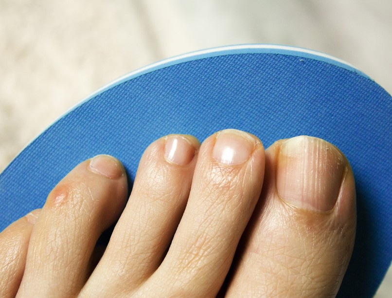 házi gyógymód módszer körömgomba ellen