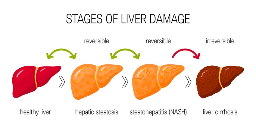A zsírmáj (steatosis hepatis) a májsejtekben felhalmozódó felesleges zsír következménye, amely leggyakrabban elhízás, 2-es típusú cukorbetegség, inzulinrezisztencia, magas vérzsírszint vagy túlzott alkoholfogyasztás miatt alakul ki. A betegség kezdetben tünetmentes, de hosszú távon májgyulladáshoz, hegesedéshez (fibrózis) és májzsugorhoz vezethet.