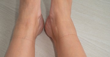 Mély nyomot hagy a zokni a lábán? Az orvosok szerint ezt az egészségügyi problémát is jelezheti