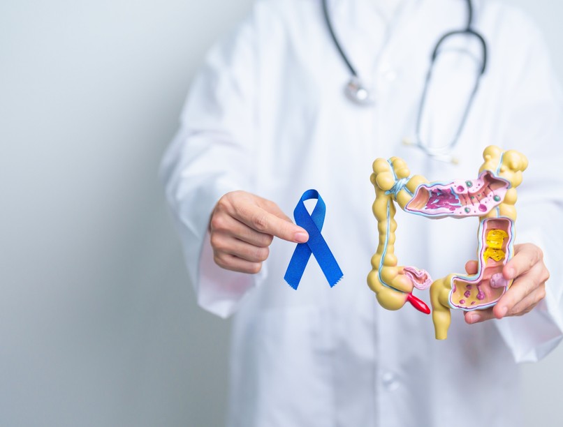 fiatal vastagbélrák nő oka életmód