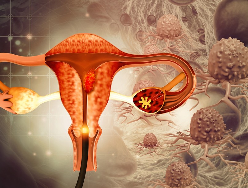 jóindulatú daganat mióma ellen