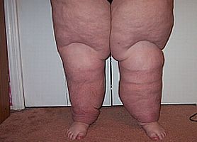 Megelőzhető-e a nyiroködéma?