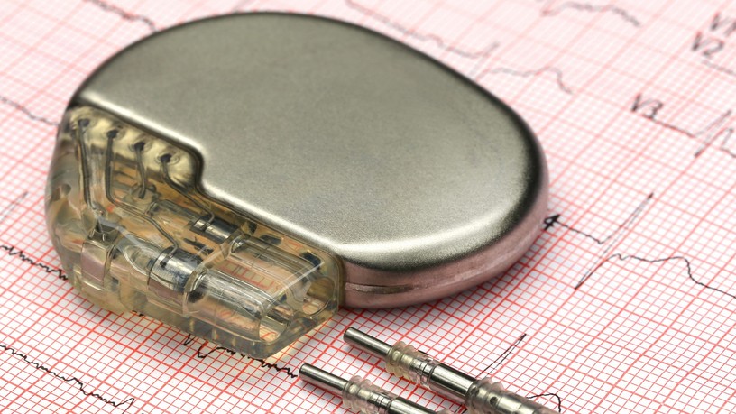 szívritmus-szabályozó kezelés abláció, pacemaker leírás