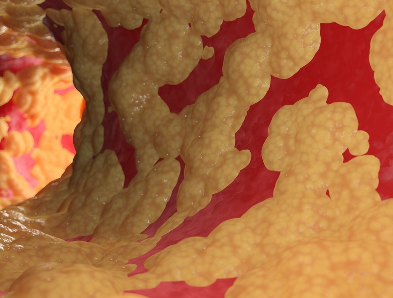 magas koleszterin szint labor eredmény