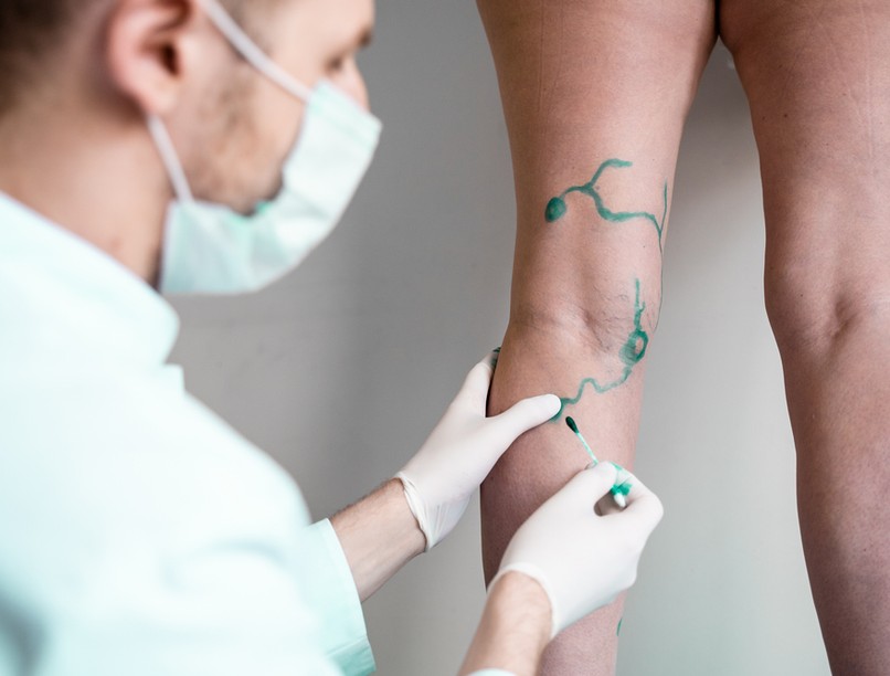 véna, visszér, viszeresség, trombózis, terhesség