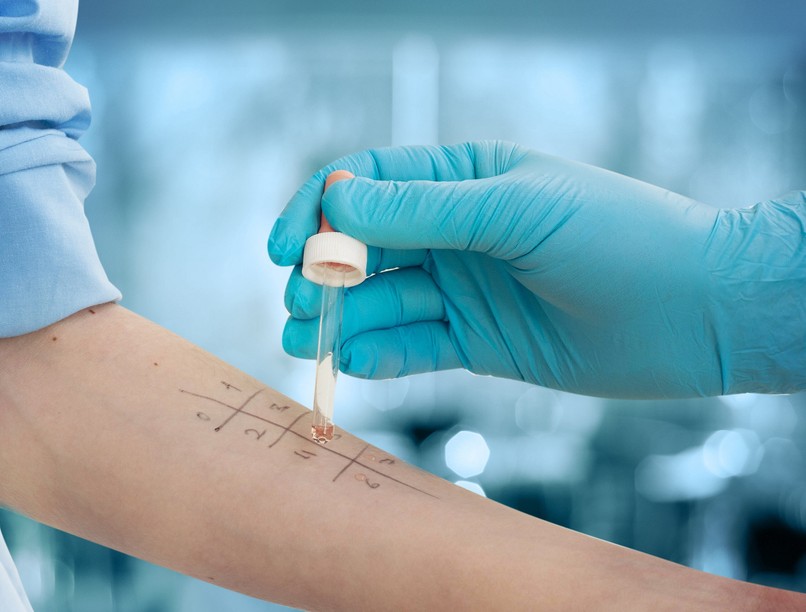 hisztamin allergia vizsgálat, értelmezése