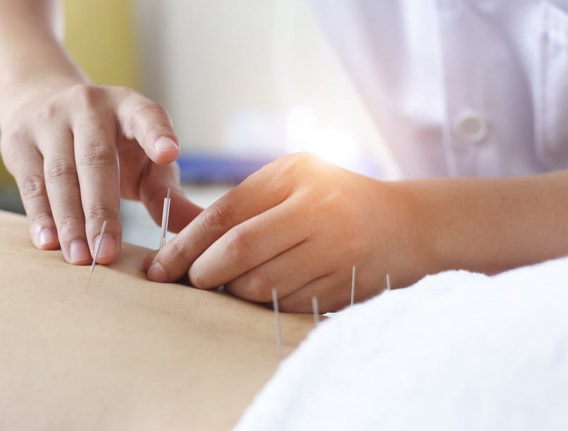 akupunktúra akupunktúrás terápia kezelés leírás
