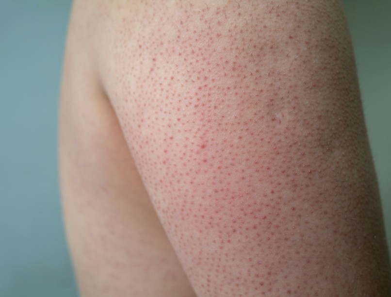 csirkebőr, bőr, gríz, bőrprobléma, keratosis pilaris