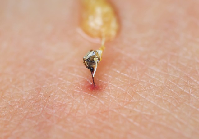 Méhcsípés és dióallergia: létezik olyan teszt, ami kimutatja? Az orvos válaszol