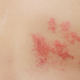 Övsömör: tünetei, vizsgálata és kezelési lehetőségei című cikk nyitóképe