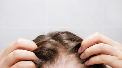 Mitől hullik a hajam? Gyakori okok, amikre kevesen gondolnak című cikk nyitóképe