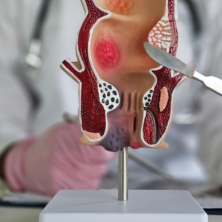 Divertikulum (béltágulat): tüntei, vizsgálata és kezelési lehetőségei című cikk nyitóképe