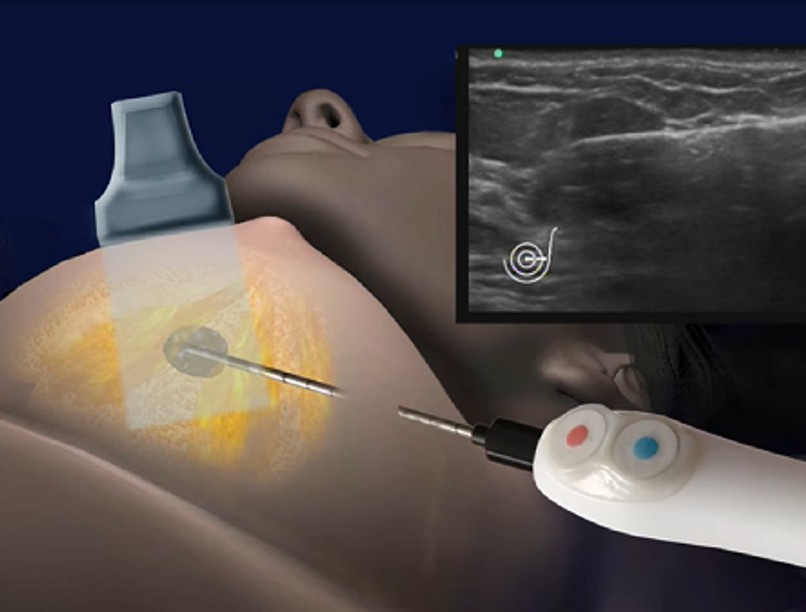 illusztracio_krioablacio