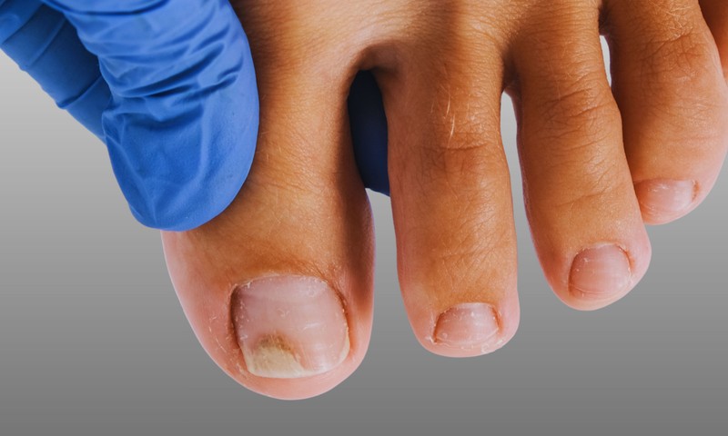 Elváltozások a körmön - innen tudhatja, hogy gomba vagy pikkelysömör okozza