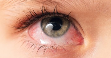  Mennyi idő alatt múlik el a kötőhártya gyulladás? 