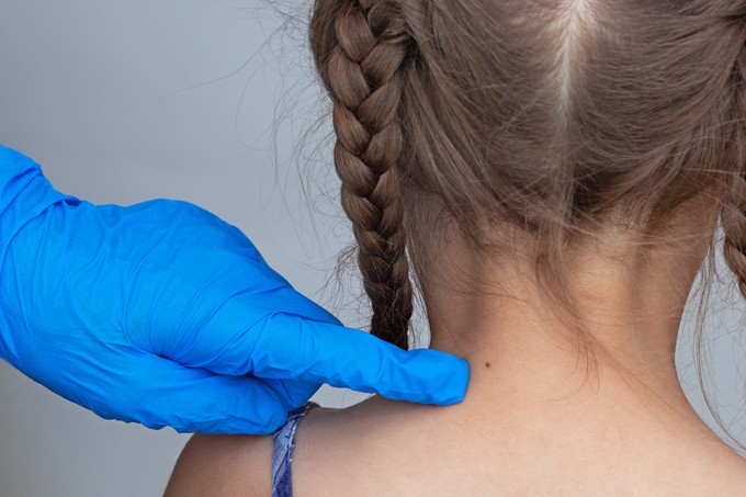 Mikor kell először elvinni a gyereket anyajegyszűrésre? című cikk nyitóképe