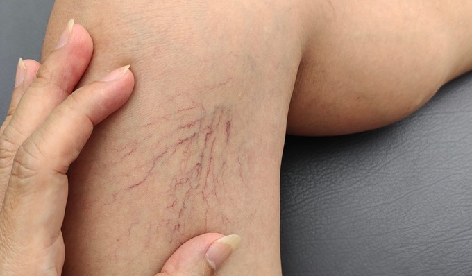 Mitől alakul ki a visszér? című cikk nyitóképe