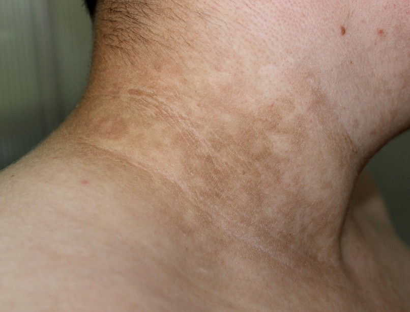 cukorbetegség diabétesz jele bőr elszíneződés