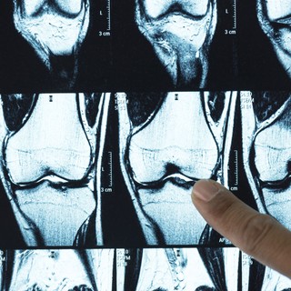 Felfedezték, miért pusztul el a porcszövet az osteoarthritisben, és hogyan lehet azt helyreállítani című cikk nyitóképe