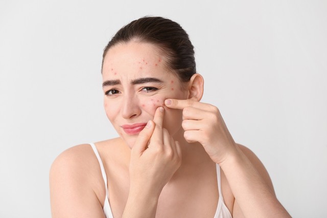 Sose nyomkodja a pattanásokat bizonyos helyeken! Ezt javasolja helyette a kozmetikus