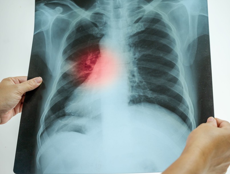 légúti betegségek tüdőgyulladás veszélyes halálos miért