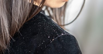  Miért korpásodik jobban a fejbőr hideg időben? 