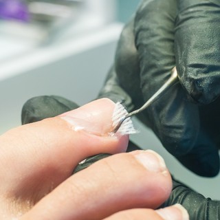 Benőtt köröm okozta fájdalmak: nemcsak a szűk cipő lehet a hibás! című cikk nyitóképe