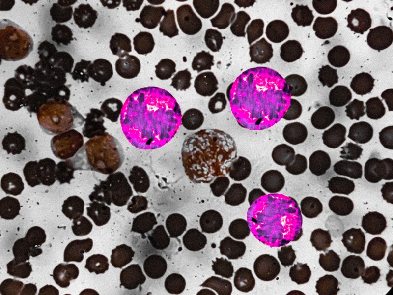 Trombocitózis, trombocitémia: tünetek, kivizsgálás és kezelési lehetőségek