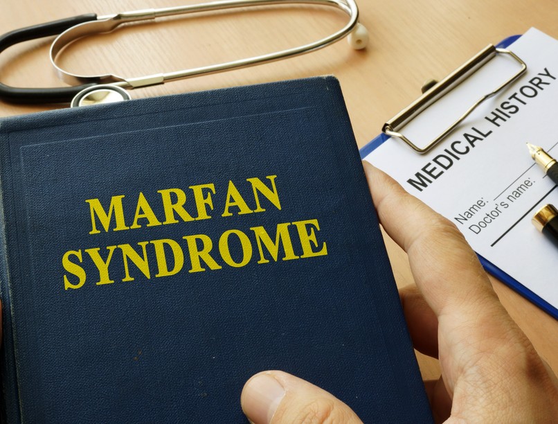 Marfan-szindróma tünet vizsgálat kezelés