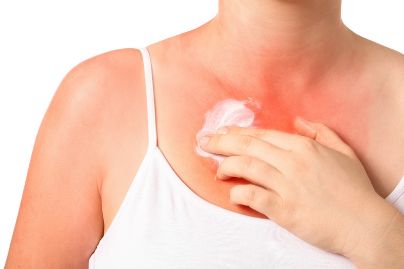 Napallergia kezelése házilag