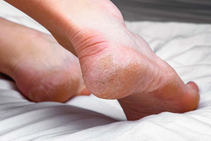 Kirepedezett sarok: komoly probléma lehet belőle, ha erre nem figyel című cikk nyitóképe