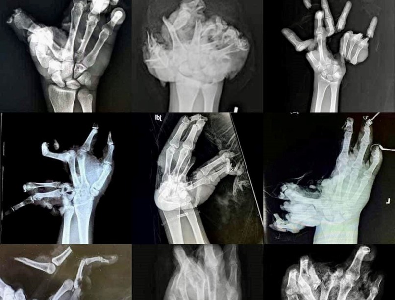 petárda szilveszter tűzijáték sérülés