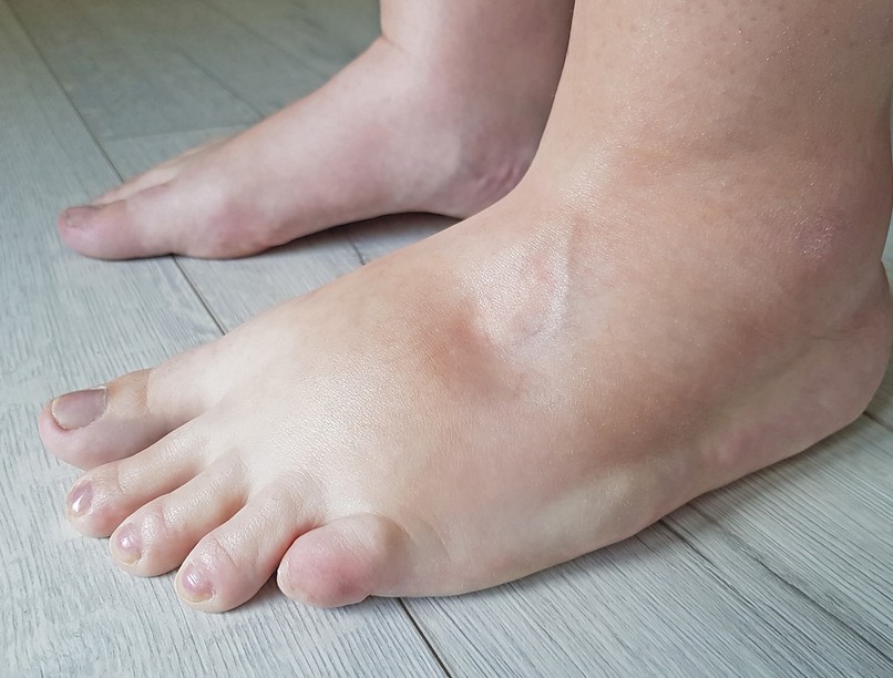 Ödéma oka jele, szívbetegség tünete