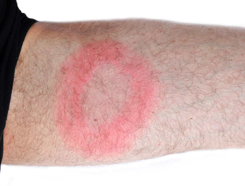 Lyme-kór meleglőzése kezelése kutatás kullancs