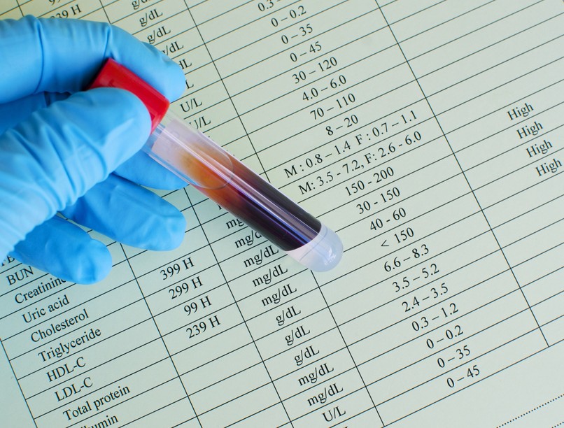 Mit jelent LDL-koleszterin érték laborlelet