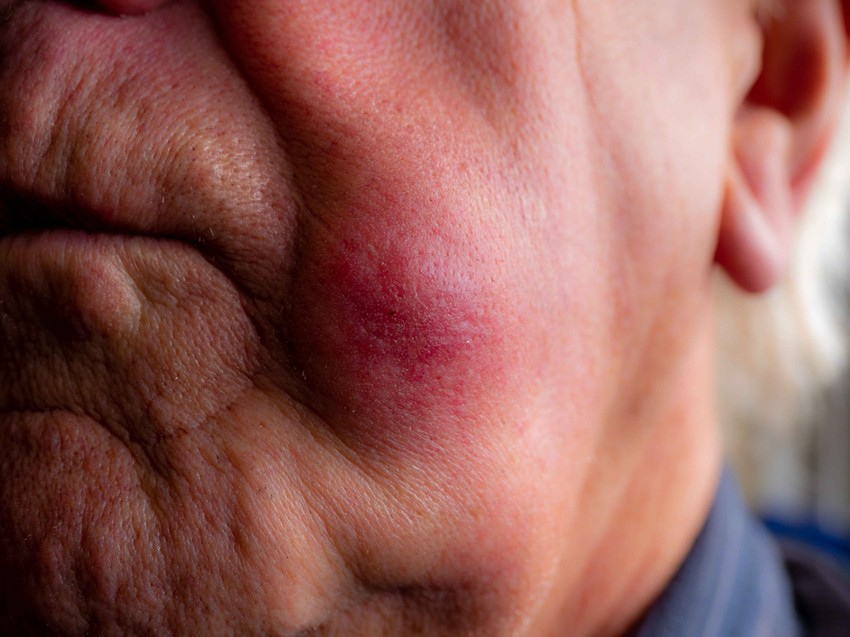 A gyomorrák csendes gyilkos: a korai stádiumokban nem jár együtt jellegzetes, vagy ijesztő tünetekkel, de az arctünetekkel való kapcsolatát kutatók bizonyították.