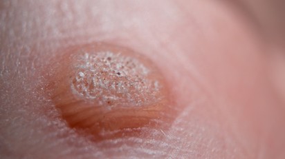 Vírusfertőzéssel terjedő szemölcs ellen ezek a bőrgyógyász legjobb tanácsai című cikk nyitóképe