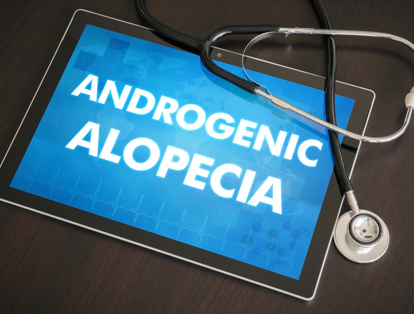 Kopaszodás, hajhullás, androgén alopécia, tünete, kezelése, férfi típusú hajhullás, női típusú hajhullás