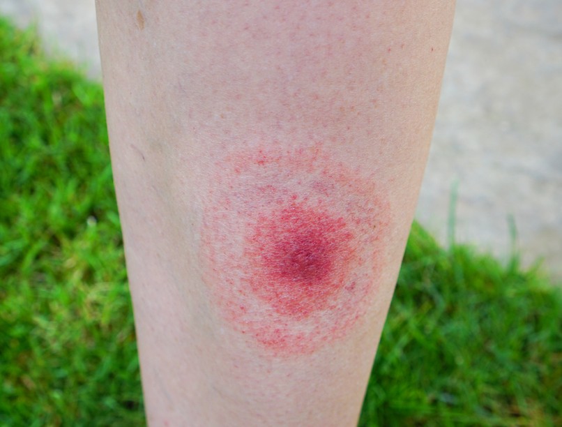 kullancs, kullancscsípés, fertőzés, Lyme-kór oka, tünetei és kezelése