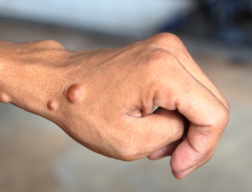 neurofibromatózis, majomhimlő, daganat, dudor