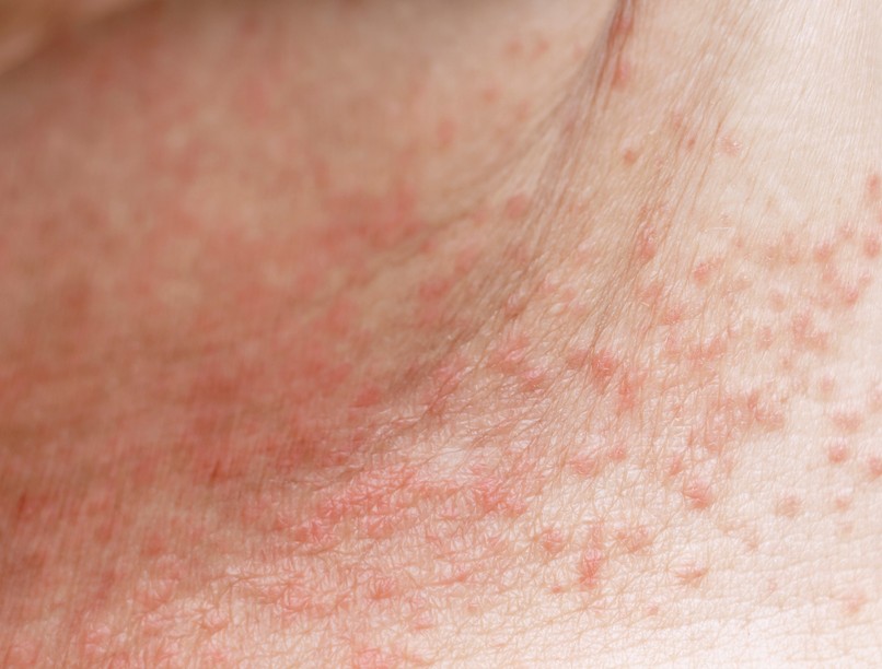 napkiütés melegkiütés allergia ellen krém napozás