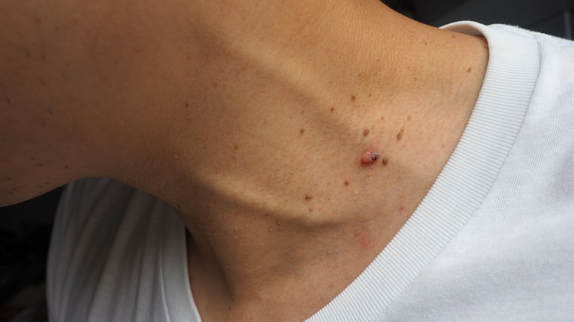 anyajegyszűrés szemölcs fibroma cukorbetegség