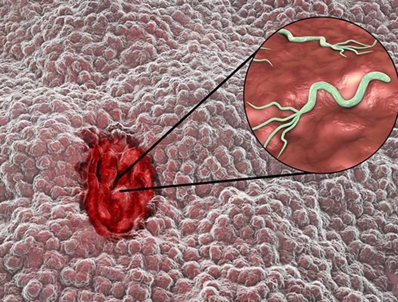 gyomorfekély, helicobacter pylori, baktérium, fertőzés, kórokozó