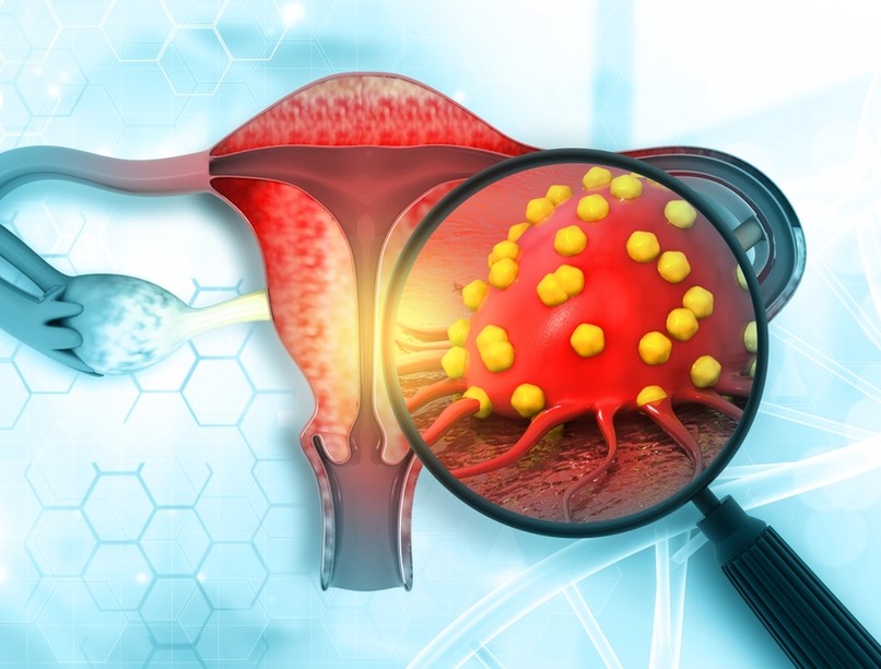 petefészekrák, petefészekdaganat, koleszterin, koleszterin gyógyszer