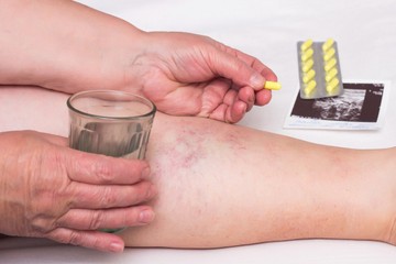 Mitől védenek a véralvadásgátlók, és mikor érdemes gyógyszert váltani?