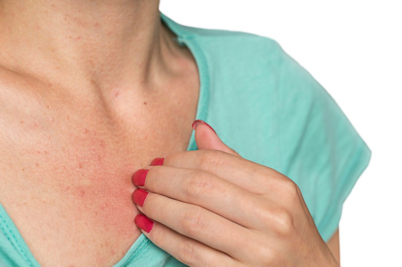 Viszkető kiütések nyáron? Ezektől a gyógyszerektől is lehet!