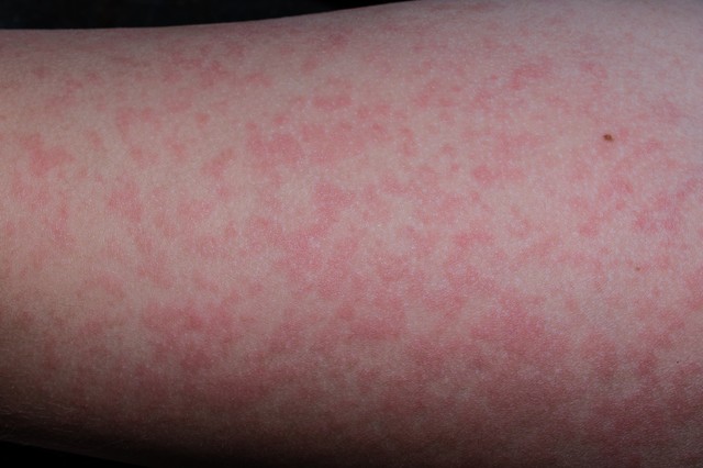 Lepkehimlő tünetei gyerekeknél