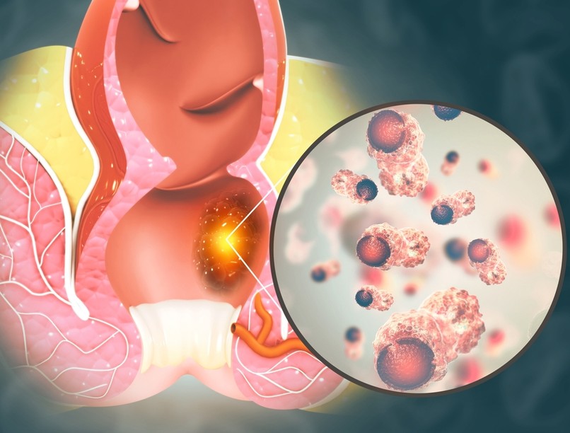 aranyér , aranyér  tünetei, aranyér  kezelése, véres széklet, székrekedés, végbélfájdalom, terhesség, gumigyűrű ligatúra, injekciós szkleroterápia, koaguláció