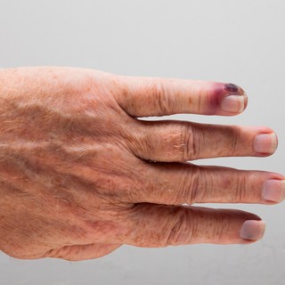 Ha ilyen piros csík indul el  a sebből a szív felé, azonnal keressen orvost! című cikk nyitóképe